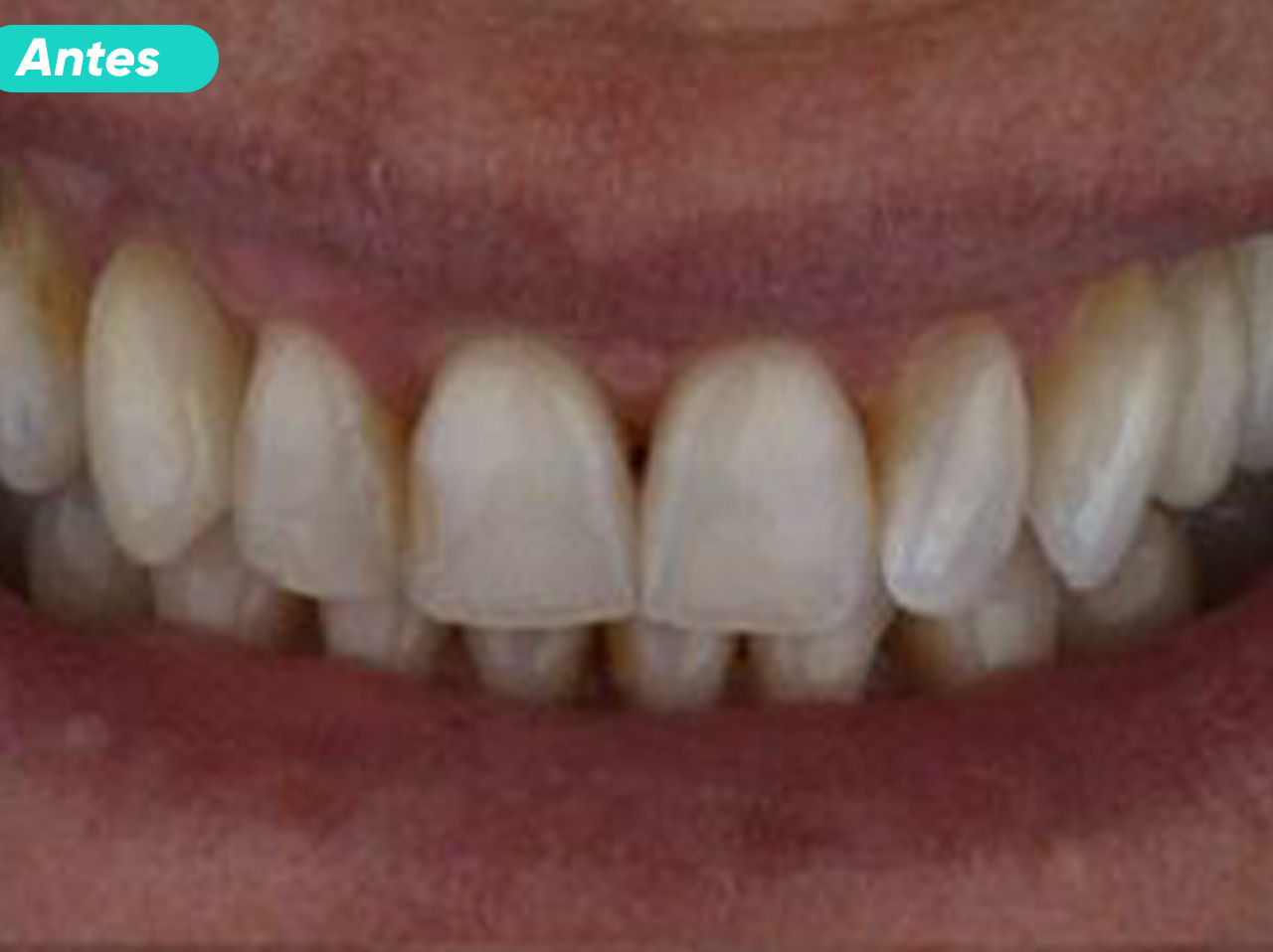 ANTES